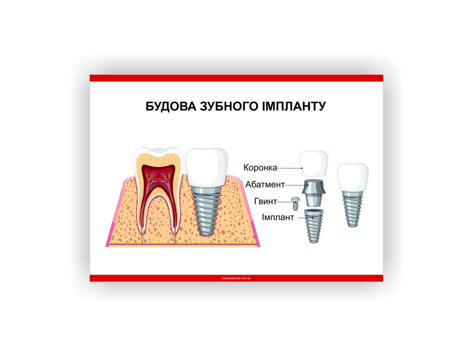 Плакат Vivay Строение зубного импланта 60х40 см (25738268)