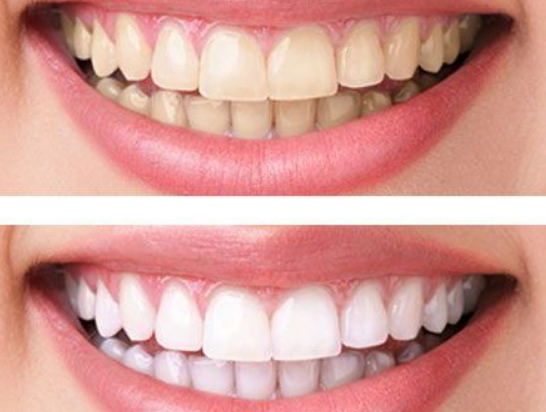 Пена для отбеливания зубов Eelhoe Baking soda 80 мл (X-507) - фото 6