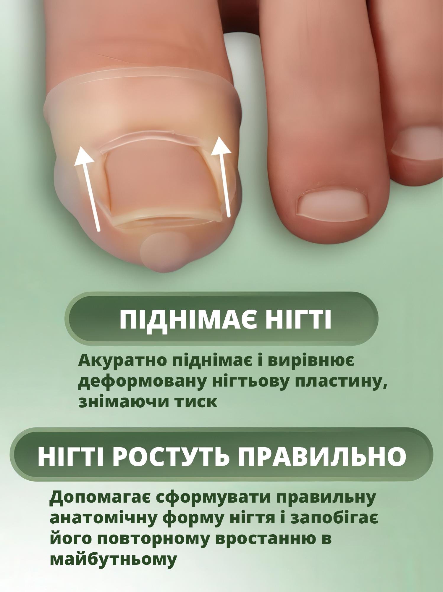 Накладки силіконові для корекції врослих нігтів 1 пара - фото 4 Накладки силіконові для корекції врослих нігтів 1 пара - фото 4