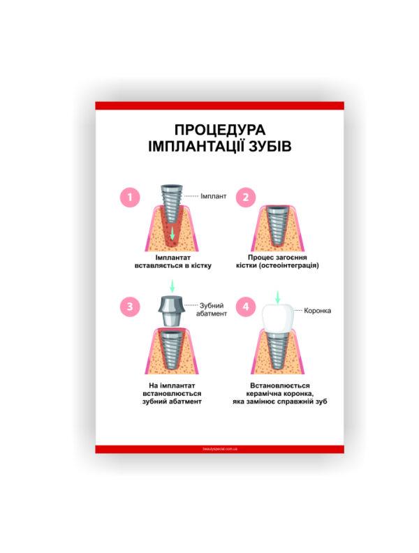Плакат Vivay "Процедура имплантации зубов" 30х40 см (25764070)
