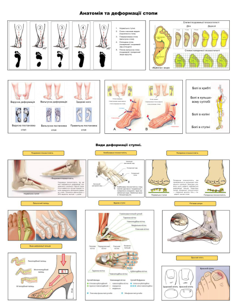 Анатомічний плакат Анатомія та деформація стопи 50x64,5 см (0035)