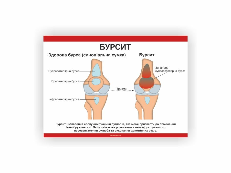 Плакат Vivay Бурсит 30х40 см (25866578)