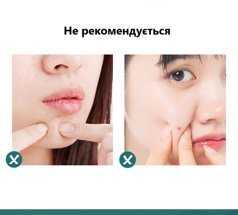 Инструменты для чистки лица из 4 игл от черных точек и угрей (U9264) - фото 5