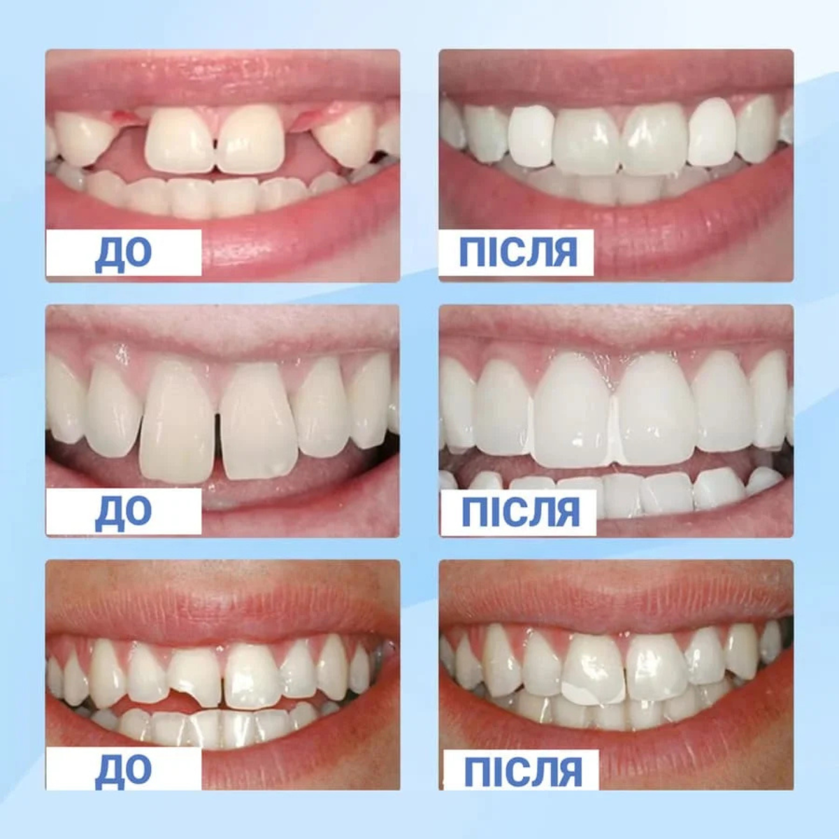Пломба временная MoldableTeeth для быстрого восстановления зубов 20 мл (2615) - фото 7 Пломба временная MoldableTeeth для быстрого восстановления зубов 20 мл (2615) - фото 7
