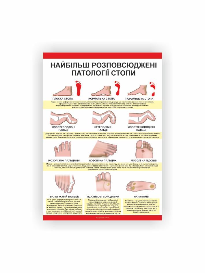 Плакат Vivay Найбільш розповсюджені патології стопи 60х40 см (25698414)
