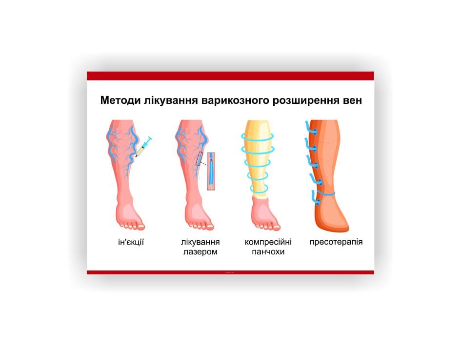 Плакат Vivay Методы лечения варикозного расширения вен 30х40 см (25671242)