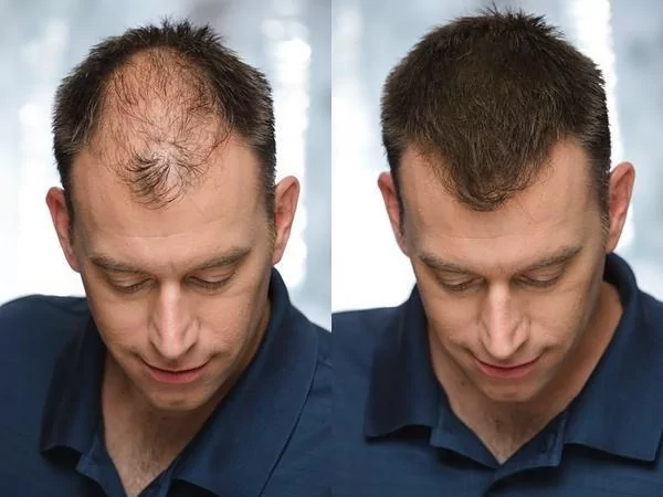 Загущувач для волосся Toppik Hair Building Fibers Auburn Темно-рудий (2573787268) - фото 3 Загущувач для волосся Toppik Hair Building Fibers Auburn Темно-рудий (2573787268) - фото 3