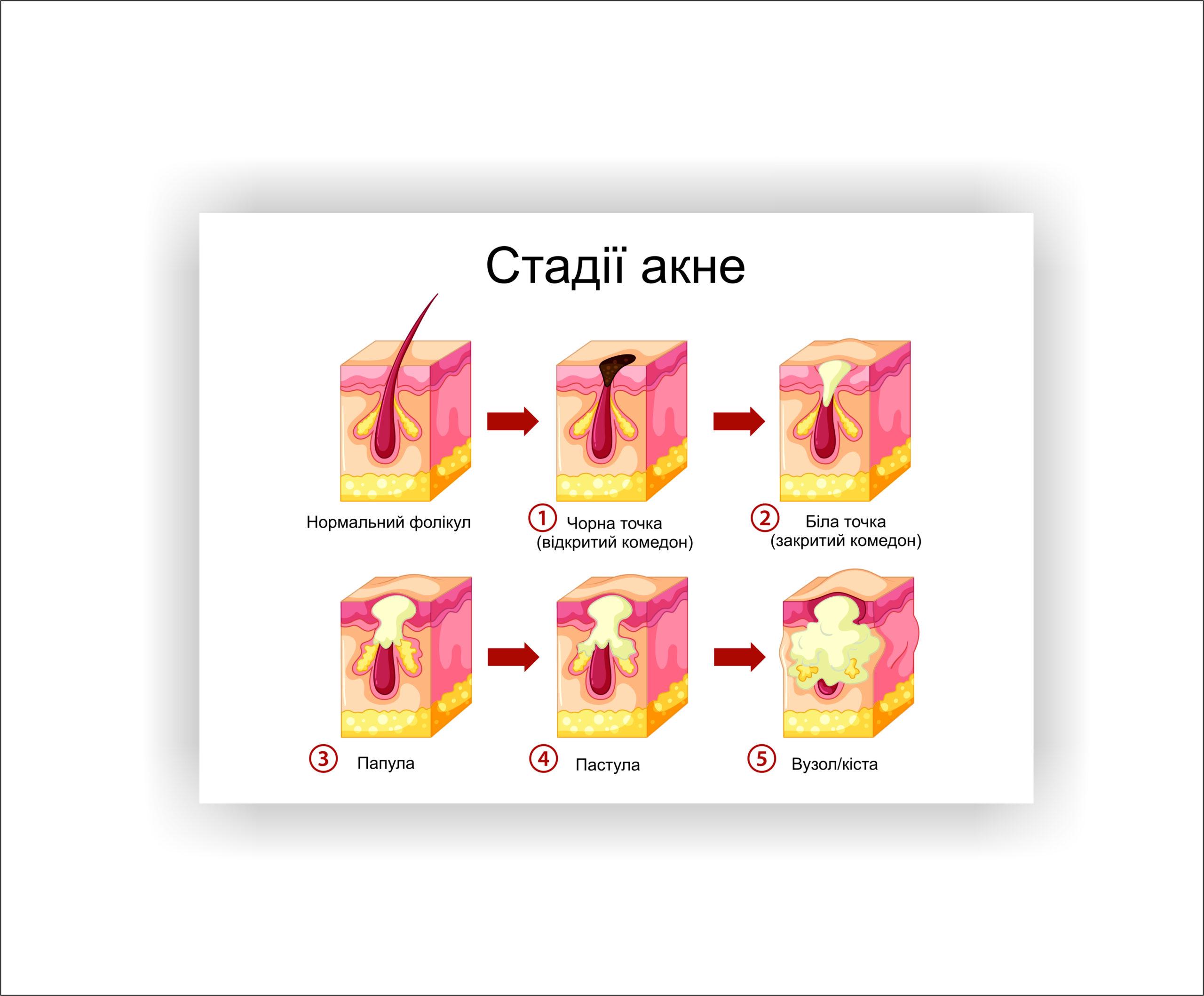 Плакат Vivay Стадии акне 60х80 см (25631591)