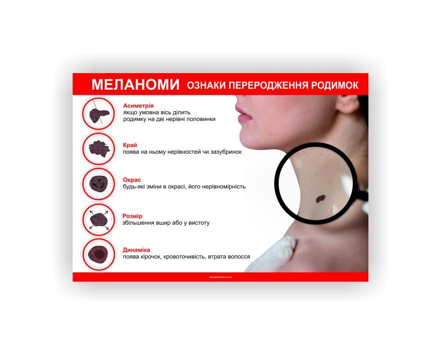 Плакат Vivay Меланомы 30х40 см (25635776)