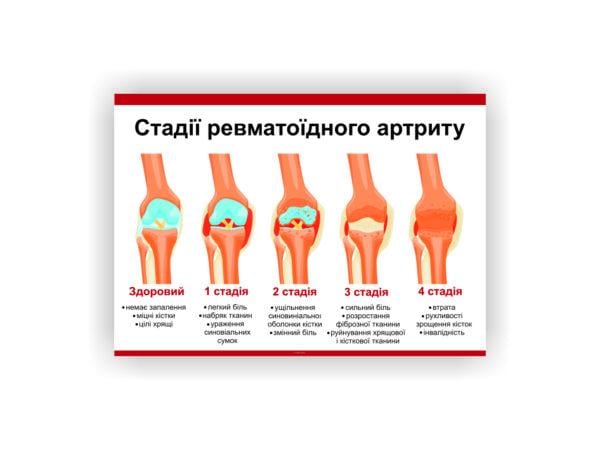 Плакат Vivay Стадии ревматоидного артрита 30х40 см (25671250)