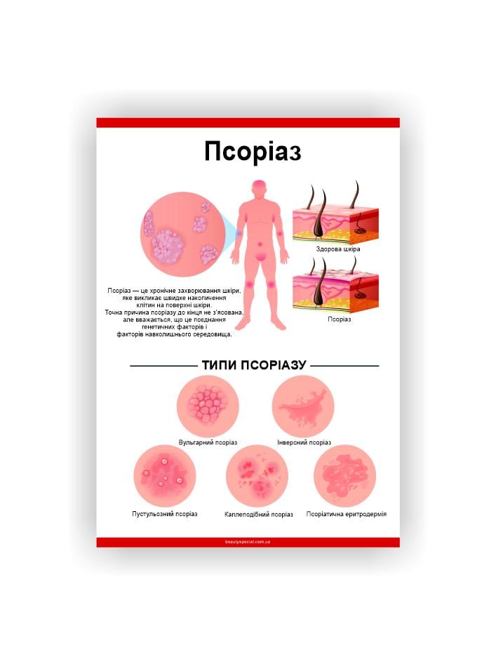 Плакат Vivay Псориаз 60х80 см (25635350)
