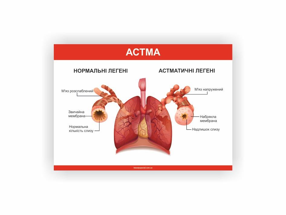 Плакат Vivay Астма 30x40 см (26945115)