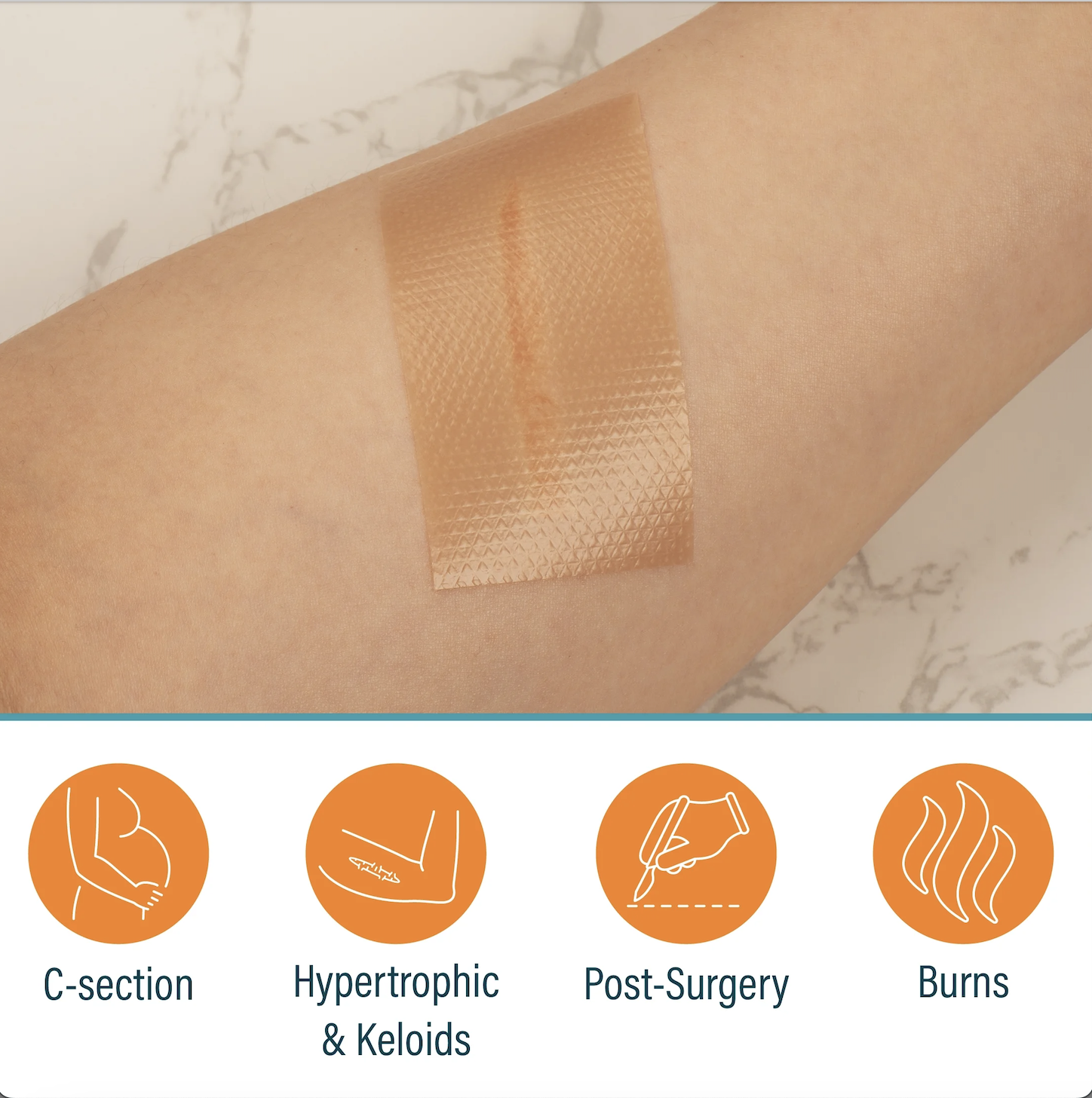 Пластырь силиконовый Nuvadermis от всех видов рубцов и шрамов 7,6х4 см 4 шт. (234567890) - фото 8 Пластырь силиконовый Nuvadermis от всех видов рубцов и шрамов 7,6х4 см 4 шт. (234567890) - фото 8