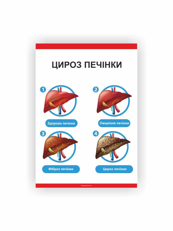 Плакат Vivay Цироз печени 60х80 см (25825671)